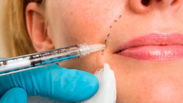 Filler Hàn Quốc có tốt không & Lưu ý khi sử dụng Filler Hàn