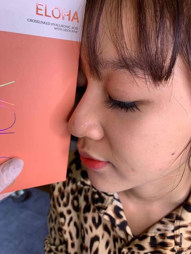 Filler có khả năng tạo hình ổn, đẹp tự nhiên, không đơ cứng Filler có khả năng tạo hình ổn, đẹp tự nhiên, không đơ cứng